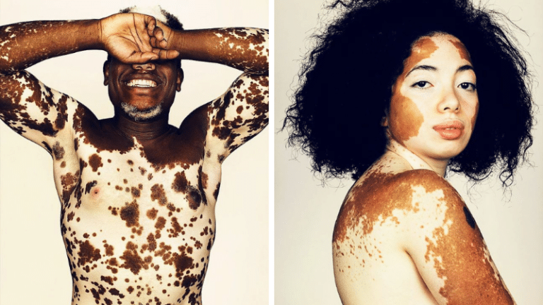 portraits vitiligo body positive photos